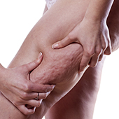 problema cellulite e buccia d'arancia localizzato su cosce