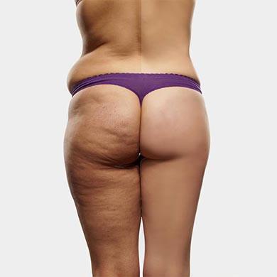 Tre rimedi naturali per la cellulite