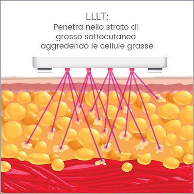 infografica lllt terapia laser bassa intensità come agisce su cellulite e grasso adiposo infografica lllt terapia laser bassa intensità come agisce su cellulite e grasso adiposo